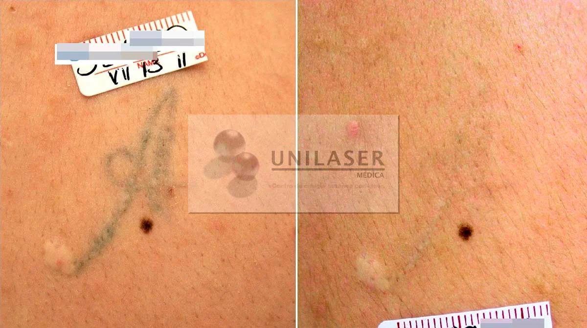 Tatuaje tenue. Comparación entre julio de 2011 y septiembre de 2012, con aclaramiento casi completo del pigmento visible.