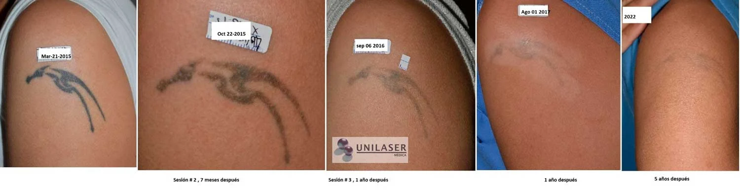 Tatuaje negro en brazo. Seguimiento desde marzo de 2015 hasta 2022. Después de tres sesiones y controles espaciados, el pigmento continuó aclarando durante los años siguientes.