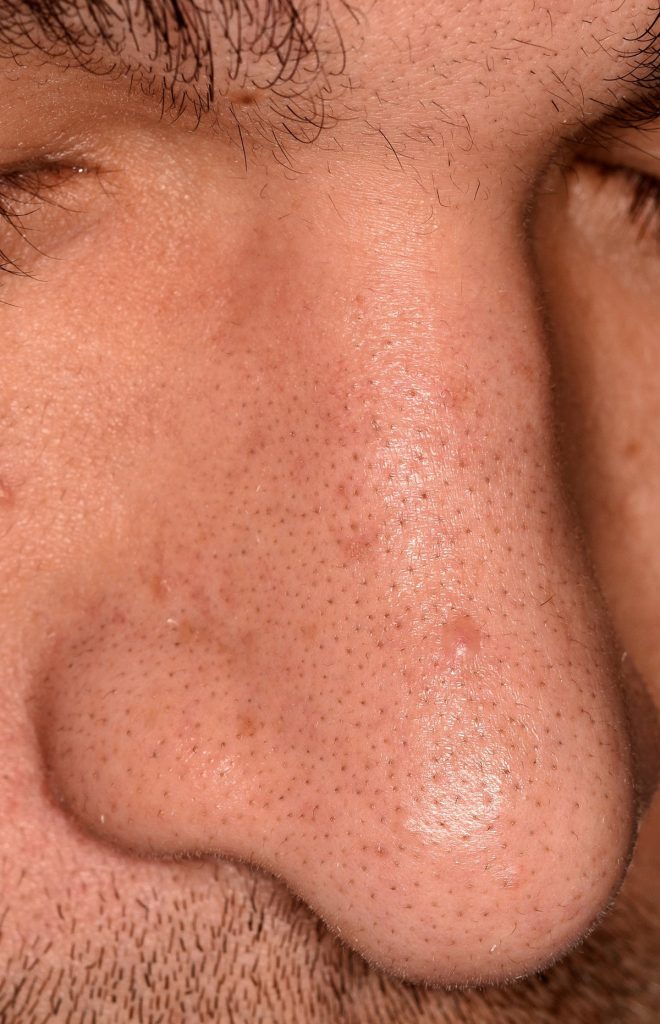 Eliminación de las pápulas fibrosas del ala nasal