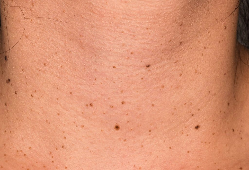 Eliminación de queratosis seborreicas con láser