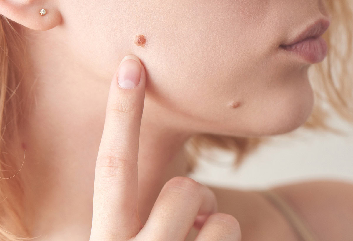 Laser mole removal