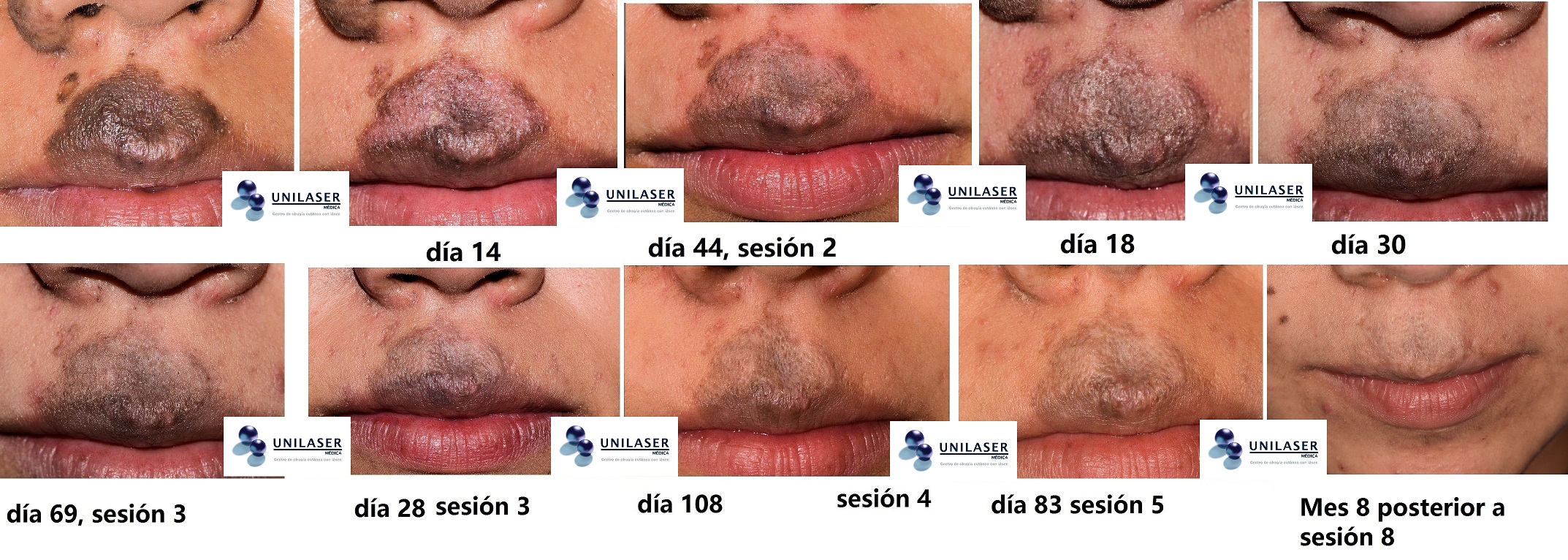 tratamiento láser de un lunar congénito en labio superior