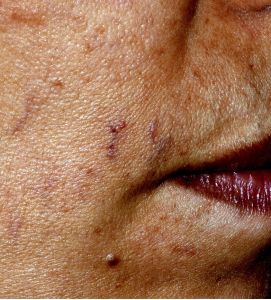 Dilataciones venosas faciales anchas superficiales