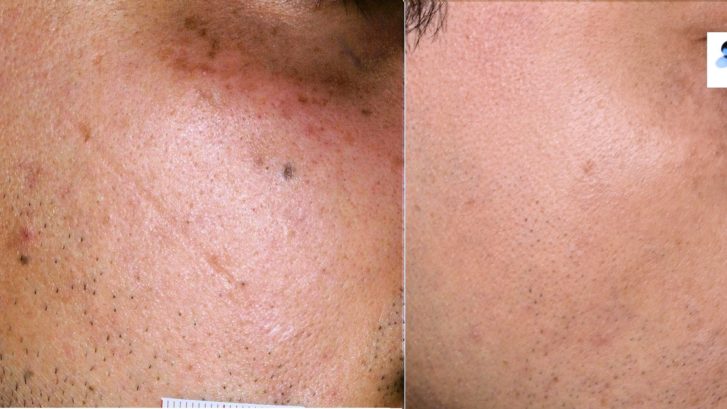 cicatrices tratadas con dermoabrasión láser